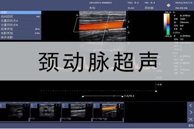 頸動脈多普勒彩超